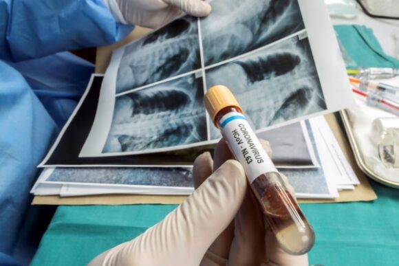 Long-Term Effects of COVID-19