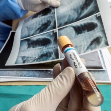 COVID-19 – skutki długoterminowe