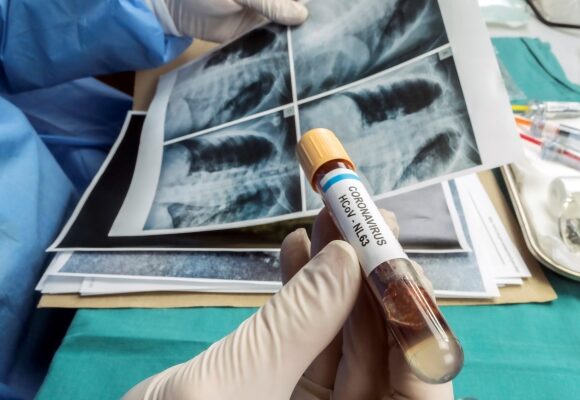 COVID-19 – skutki długoterminowe