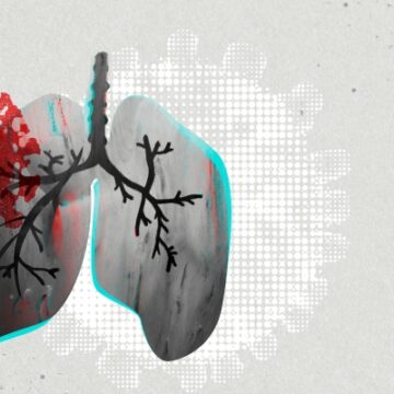 How Severe COVID-19 Can Tragically Lead to Lung Failure and Death