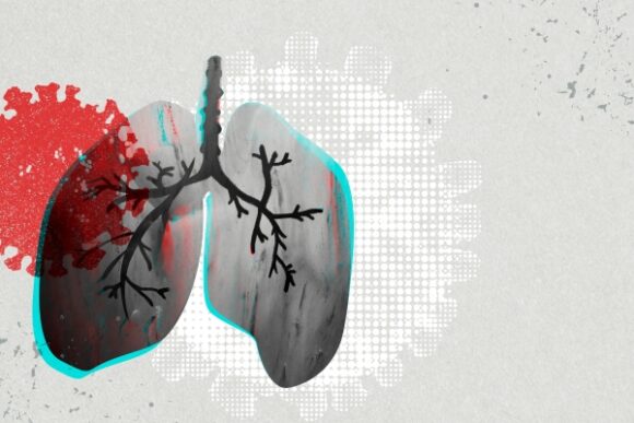 How Severe COVID-19 Can Tragically Lead to Lung Failure and Death