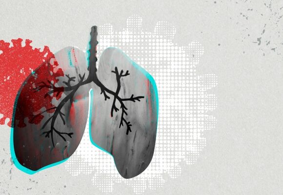 Jak ciężki przebieg COVID-19 może doprowadzić do niewydolności płuc i śmierci